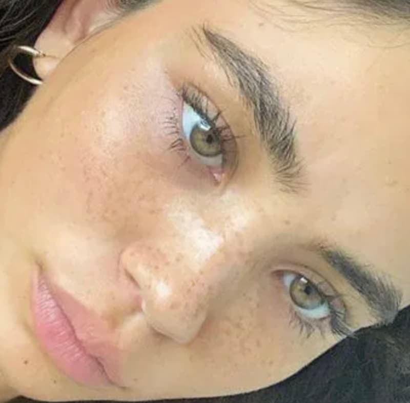 Tâches de rousseurs